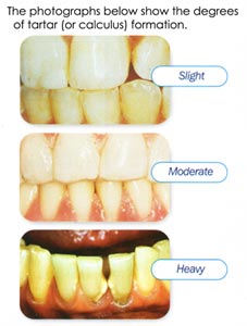 Yellow plaque on shop teeth