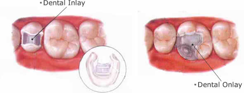 Dental Bridges and Teeth Crowns