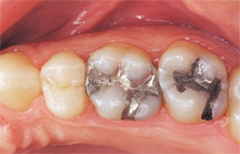 metal fillings