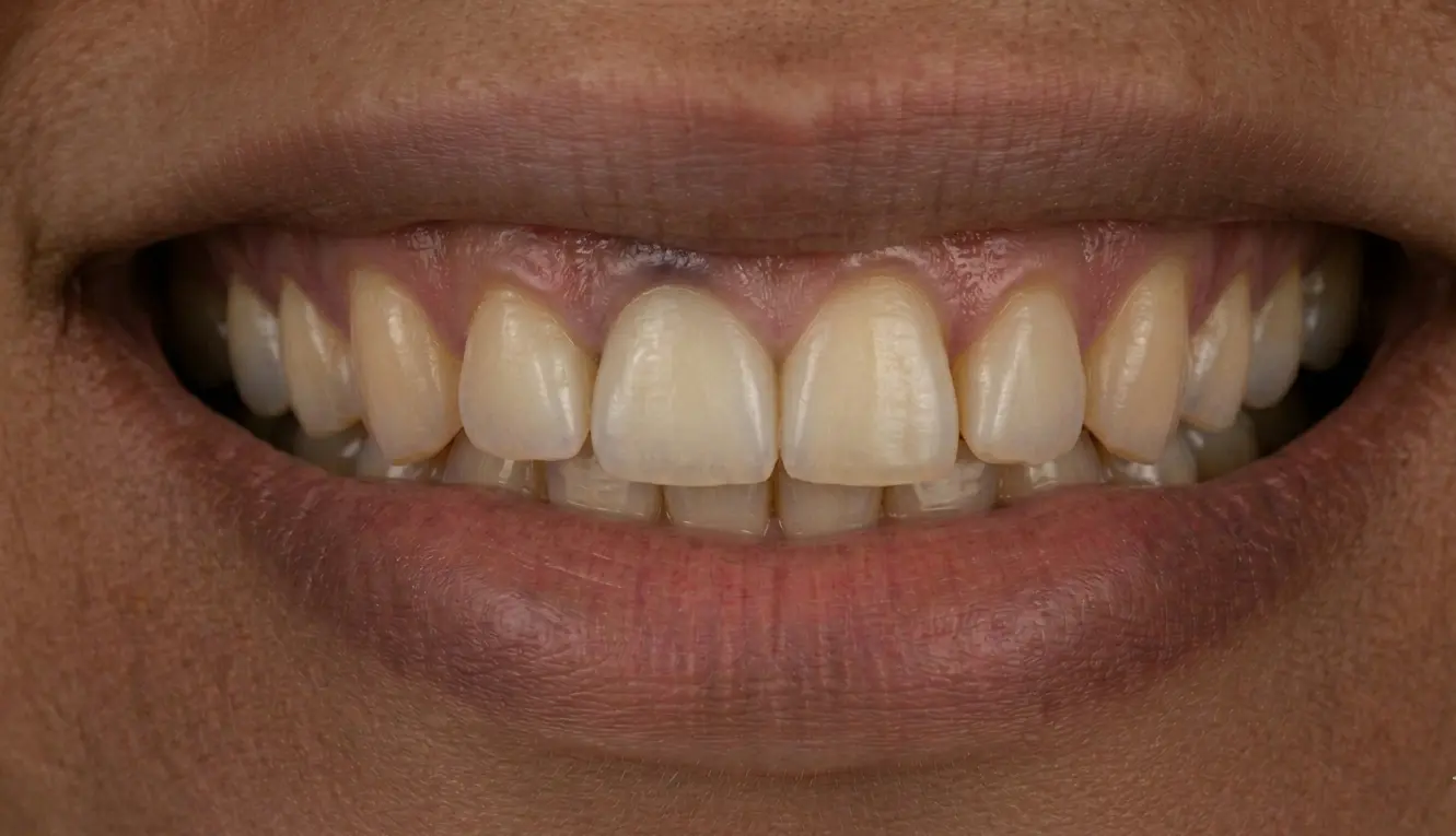 After: Implant — front tooth replacement