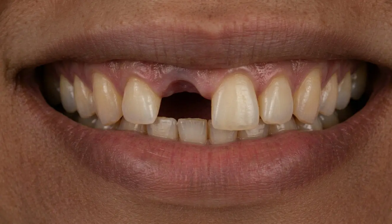 Before: Implant — front tooth replacement