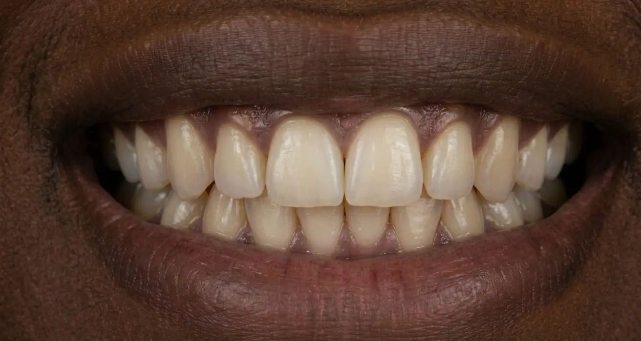 After: Invisalign — severe crowding and rotation