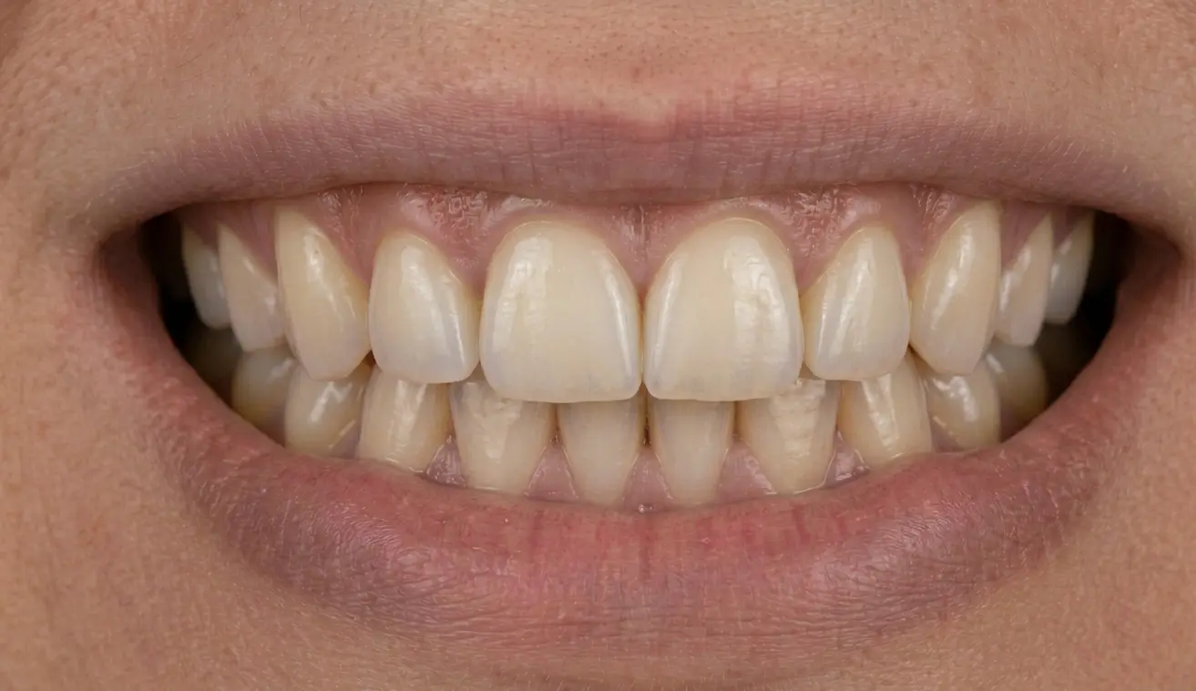 After: Veneers — discoloration & alignment correction