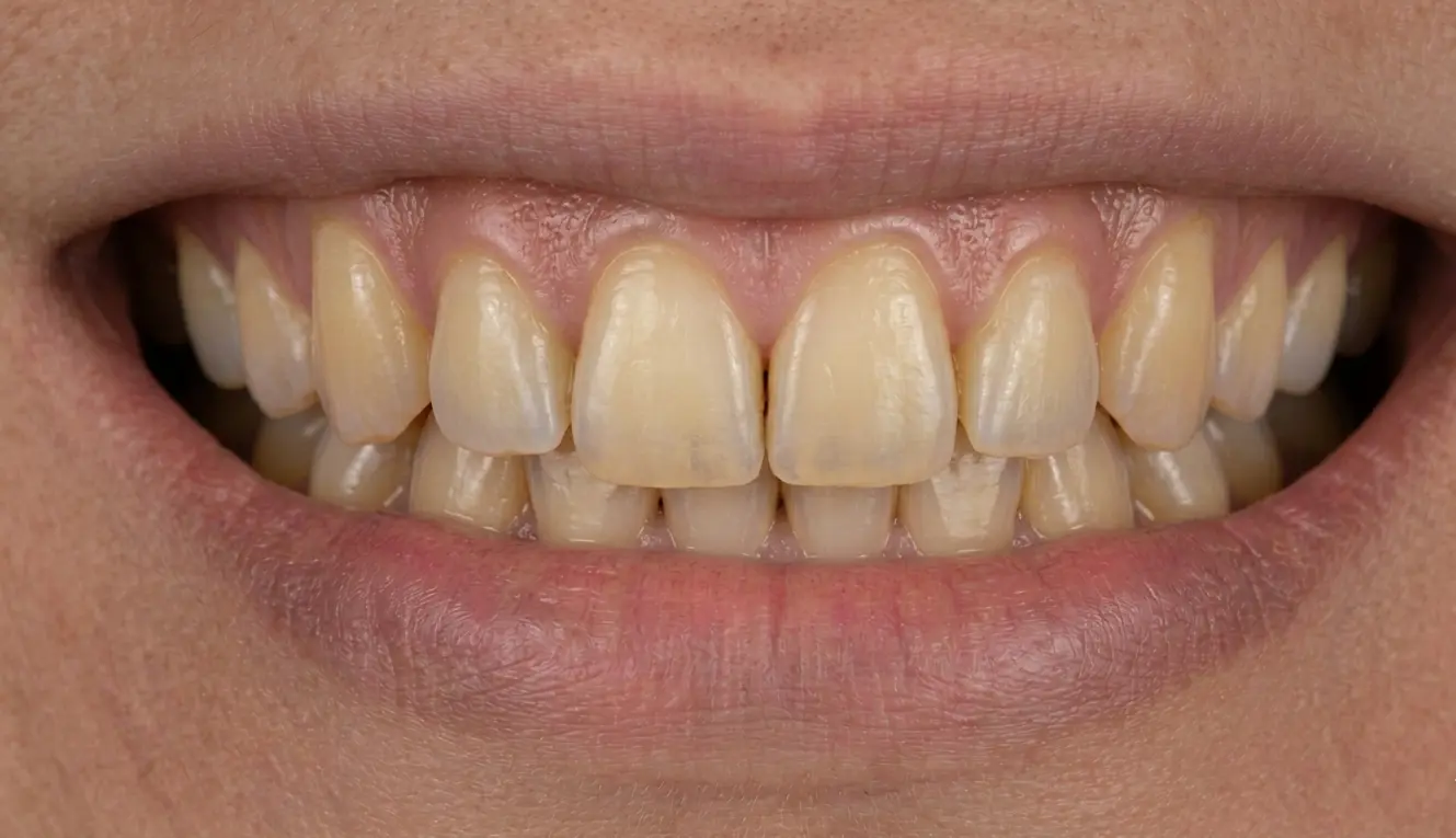 Before: Whitening — heavy discoloration