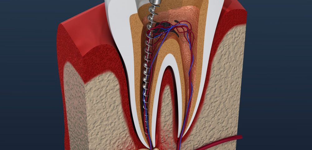 Root Canal