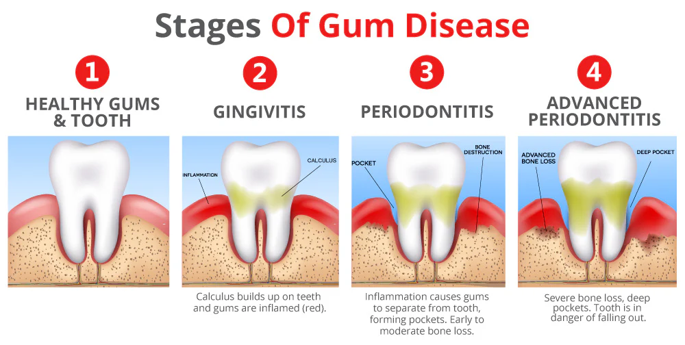 Stages of Gum Disease