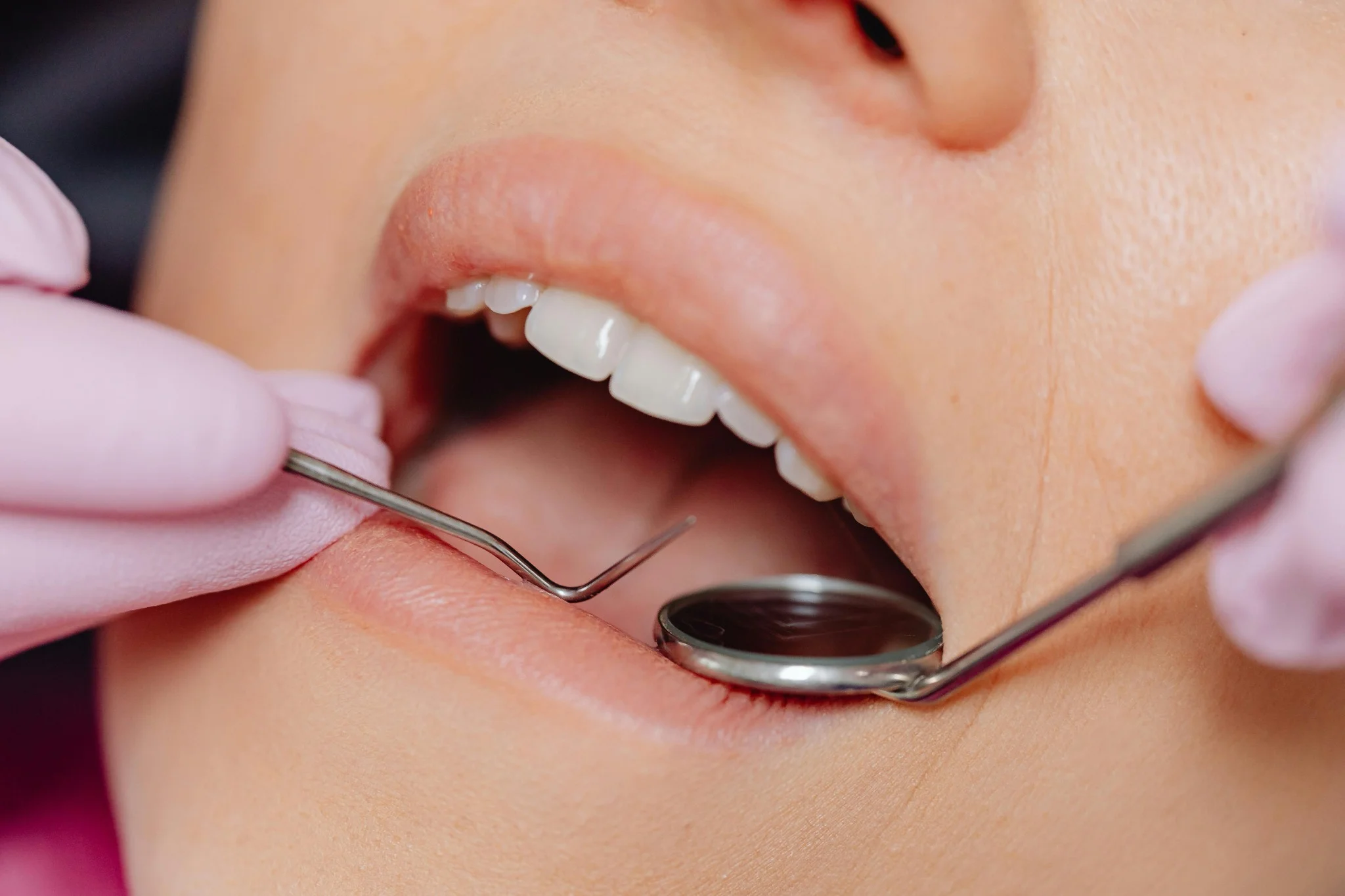Professional dental cleaning at Spring Valley Dental in North Dallas